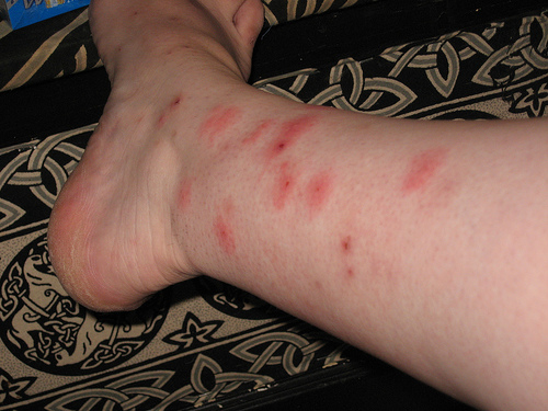 What do bed bug bites look like?